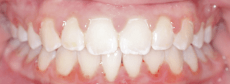 Before treatment