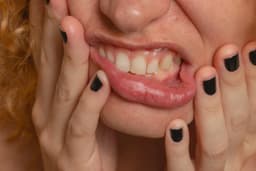 Gum Recession: Why Gums Pull Back and How to Protect Your Roots