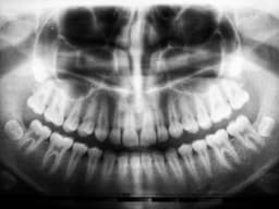 Wisdom Teeth Removal: What to Expect Before, During, and After