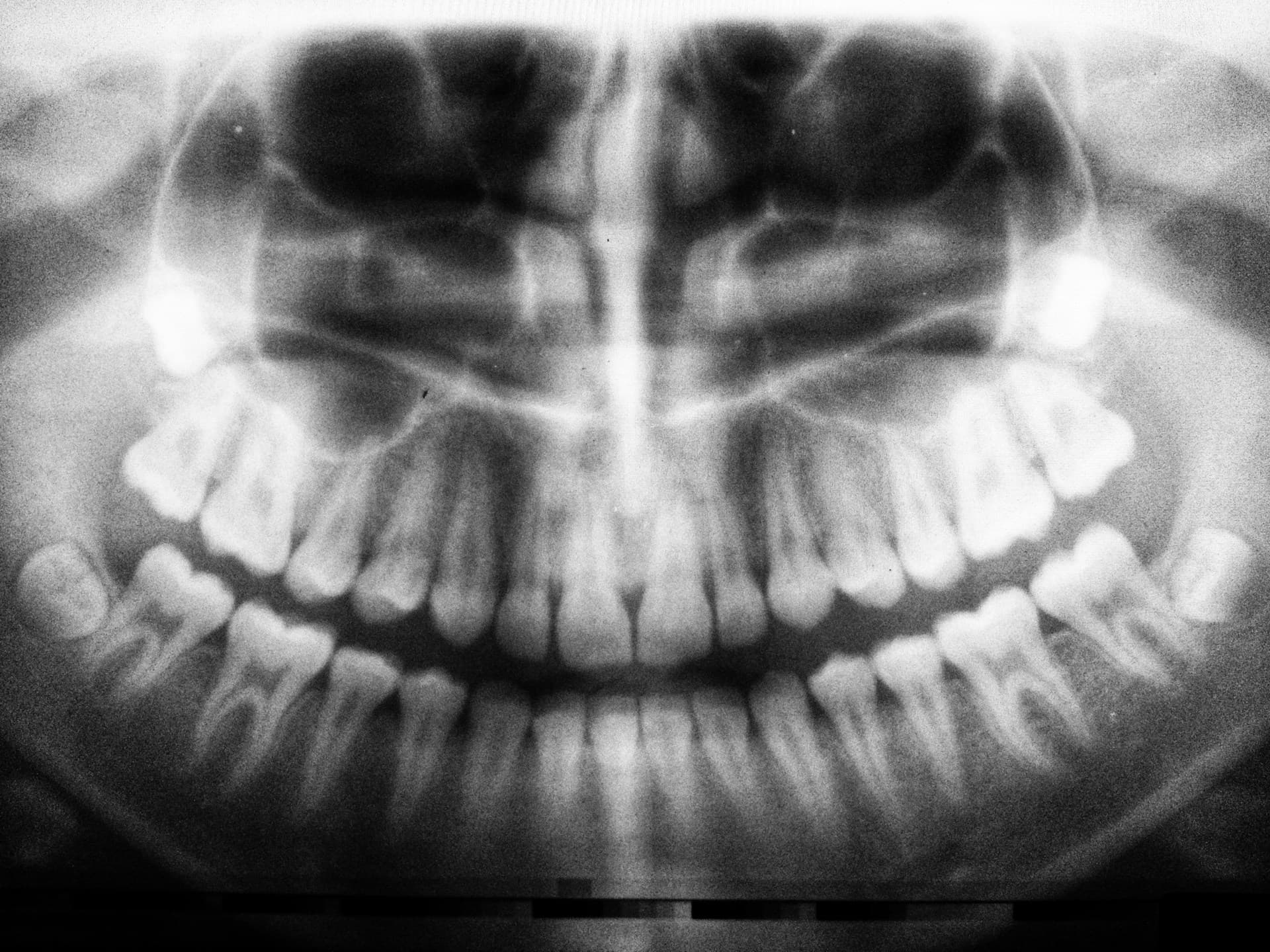 Wisdom Teeth Removal: What to Expect Before, During, and After